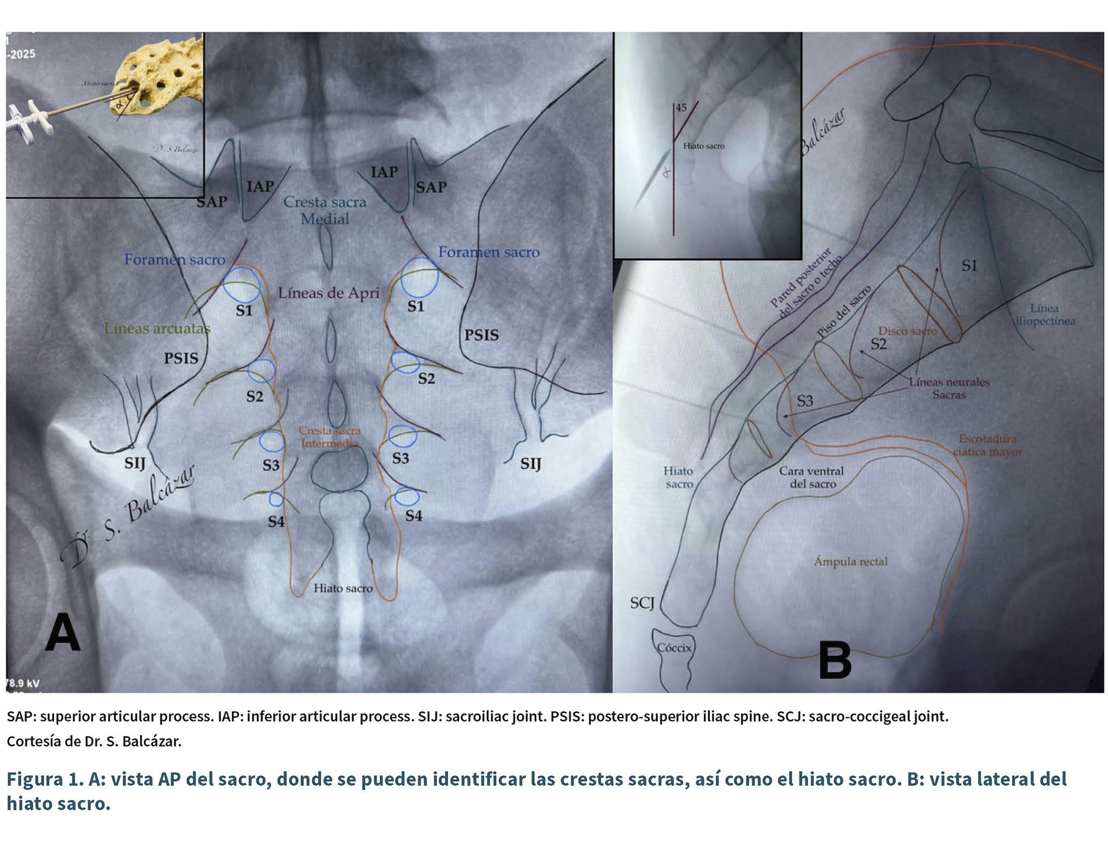 Vista radiográfica con anotaciones que identifican estructuras óseas y ligamentos en la región sacra y pélvica.

Descripción generada con IA