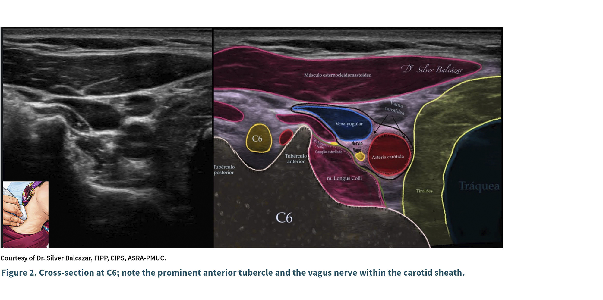 Se muestra una imagen de ultrasonido en corte transversal del nivel C6 del cuello con una ilustración superpuesta que destaca la tuberosidad anterior y el nervio vago dentro de la vaina carotídea junto a estructuras anatómicas como la tráquea y arterias.

Descripción generada con IA