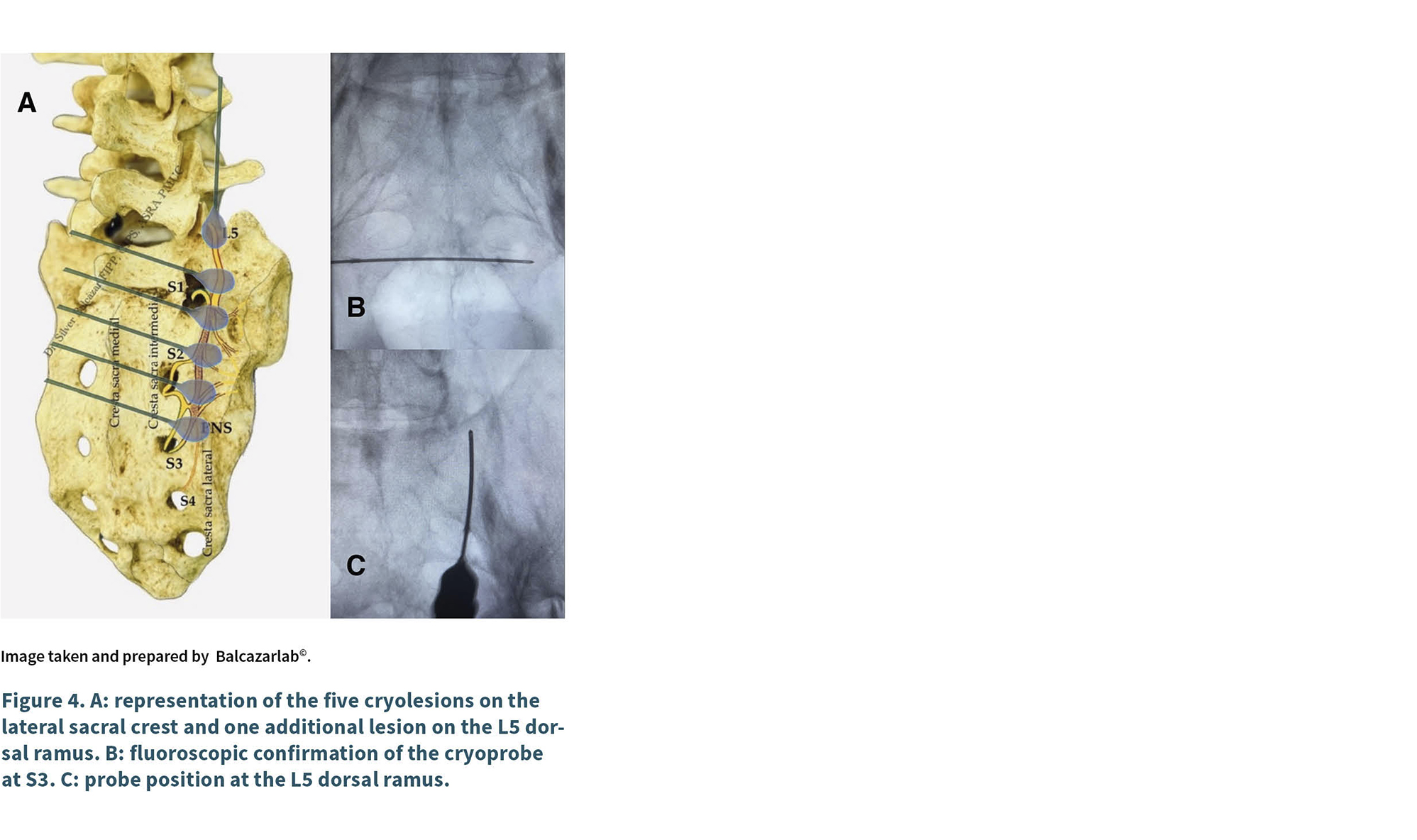 Representación anatómica y radiográfica de cinco criocisiones en la cresta sacra lateral y una lesión adicional en el ramo dorsal L5 con confirmación fluoroscópica y posición de la sonda en el ramo dorsal L5.

Descripción generada con IA