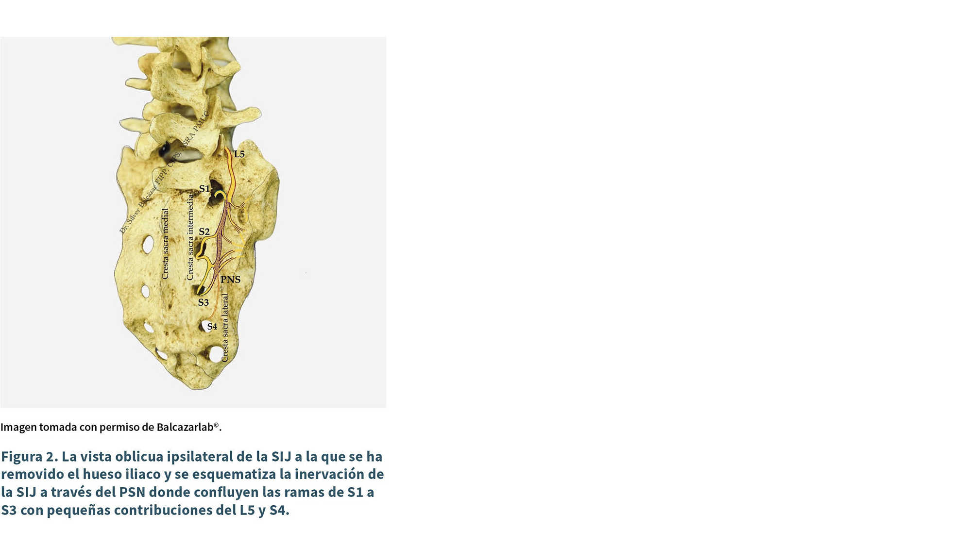 Vista oblicua de la columna sacra y hueso ilíaco con anotaciones que muestran la inervación de la raíz S1 y ramas del plexo sacro.

Descripción generada con IA
