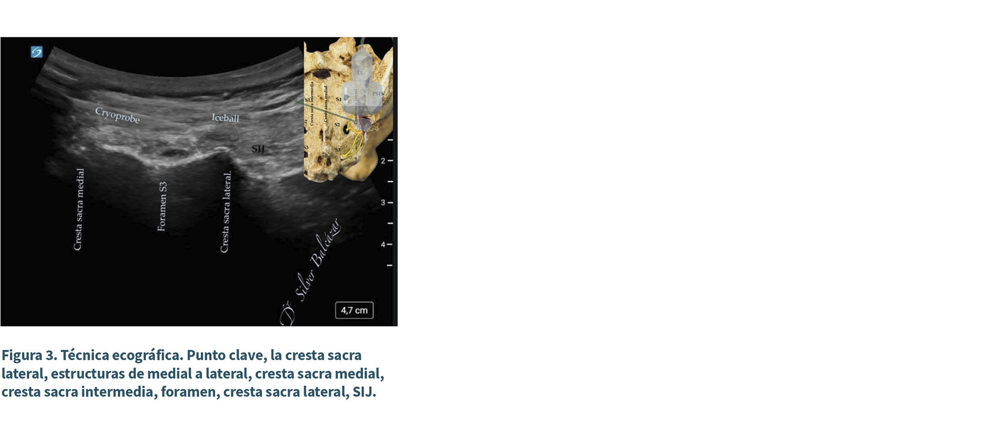 Ultrasonido que muestra la técnica ecográfica de la cresta sacra lateral con etiquetas de estructuras anatómicas y una imagen ilustrativa al lado derecho.
Descripción generada con IA