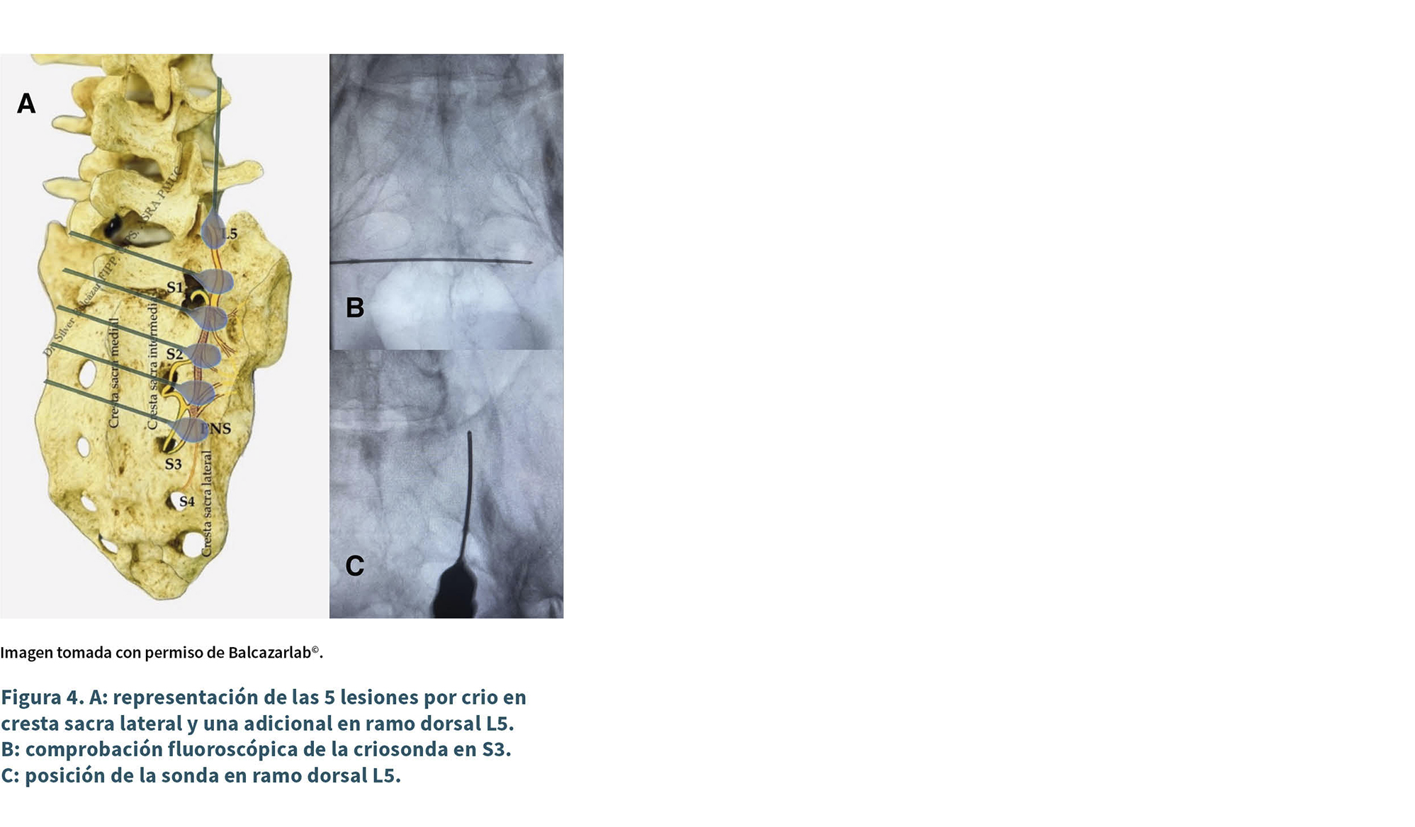 Representación anatómica de lesiones por crio en cresta sacra lateral y ramo dorsal L5 junto con imágenes fluoroscópicas que muestran la comprobación y posición de una sonda en el ramo dorsal S3 y L5.

Descripción generada con IA