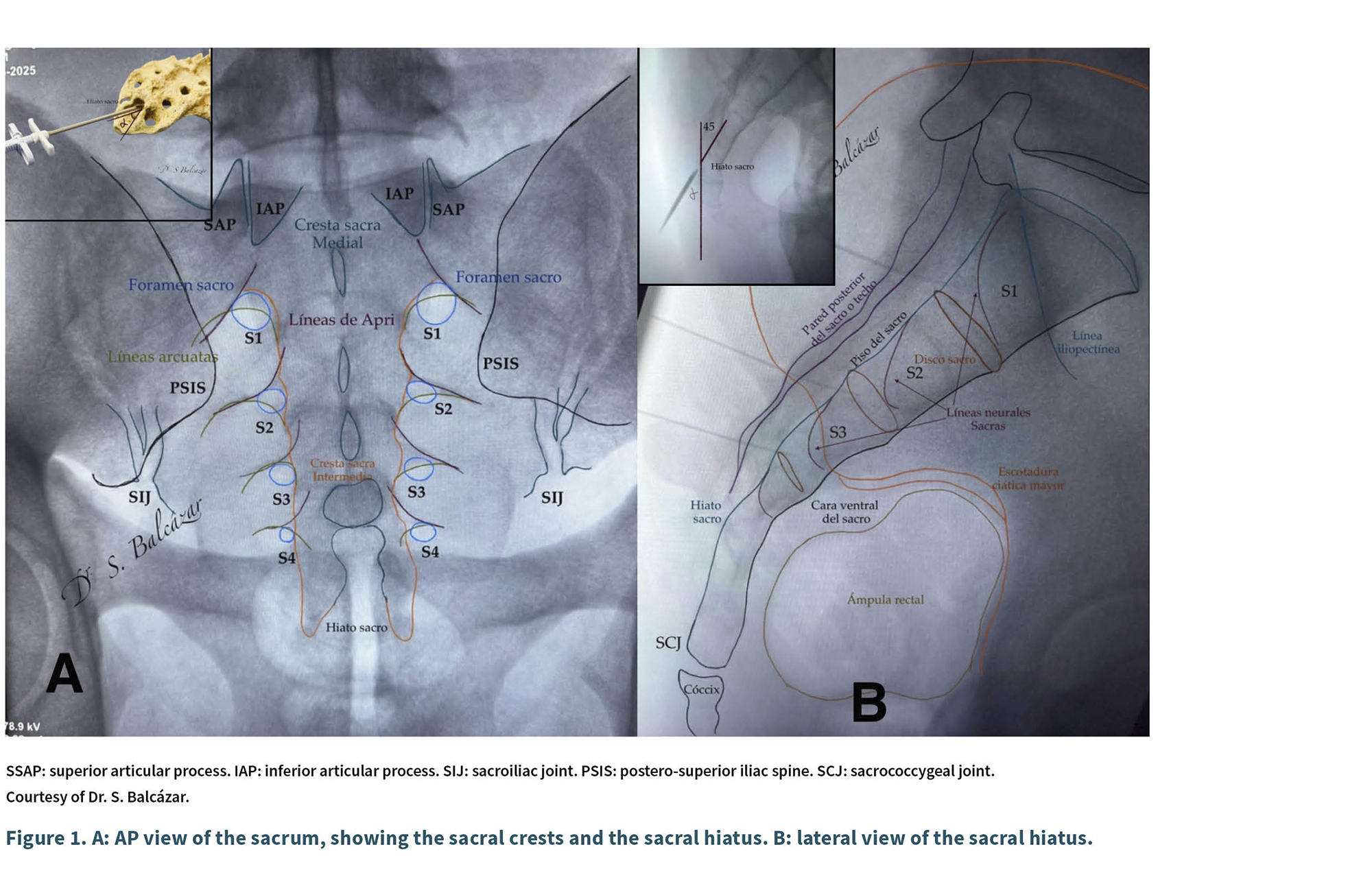 Vista anteroposterior y lateral del sacro con etiquetas que señalan las crestas sacras y el hiato sacro en un estilo de imagen médica radiográfica con superposiciones anatómicas.

Descripción generada con IA