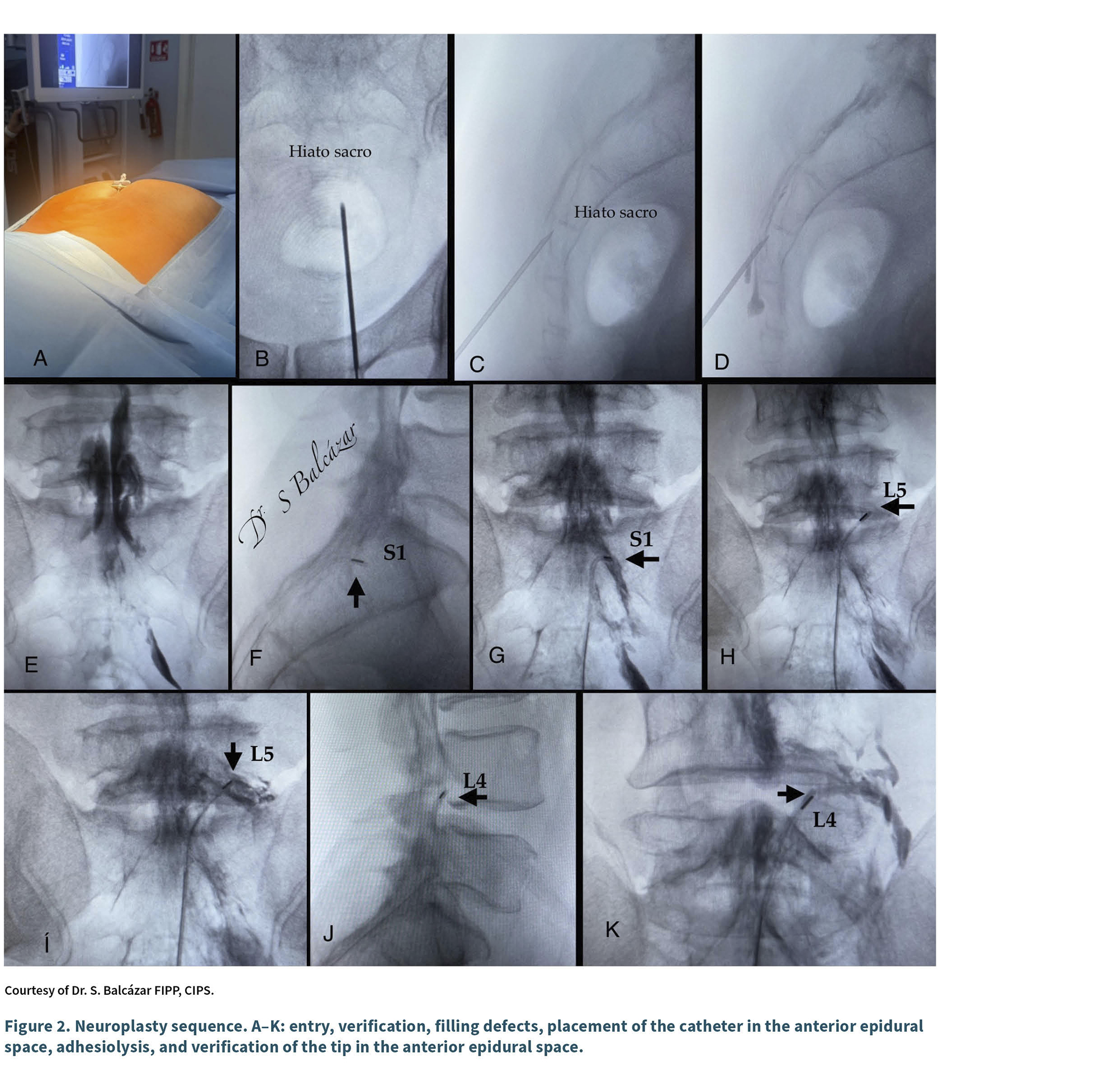 Secuencia de imágenes radiográficas y fotográficas que muestran la entrada, verificación, llenado de defectos, colocación y adhesiolisis de un catéter en el espacio epidural anterior con indicaciones anatómicas y niveles vertebrales.

Descripción generada con IA