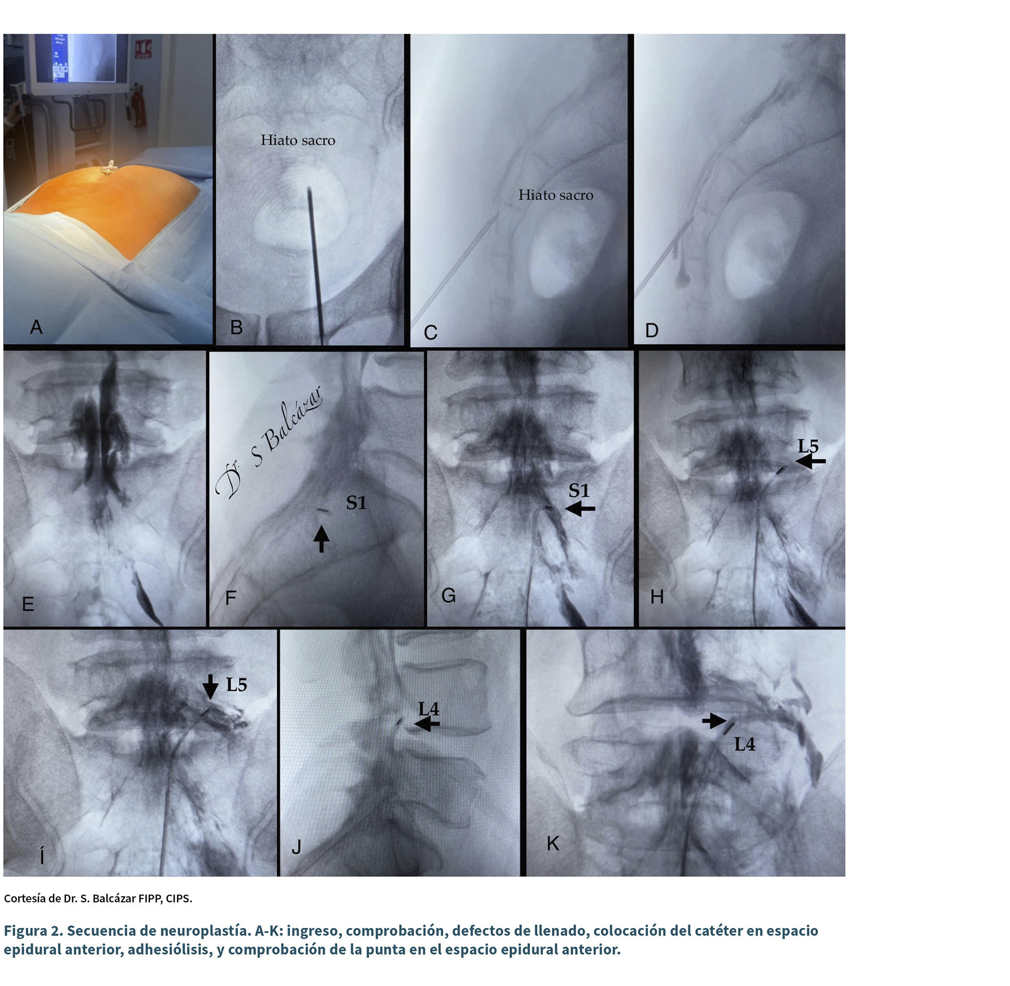 Secuencia de imágenes radiográficas y clínica que muestran el procedimiento de ingreso, comprobación, detección de defectos de llenado, colocación del catéter en el espacio epidural anterior y adhesiolisis durante una neurocirugía.

Descripción generada con IA