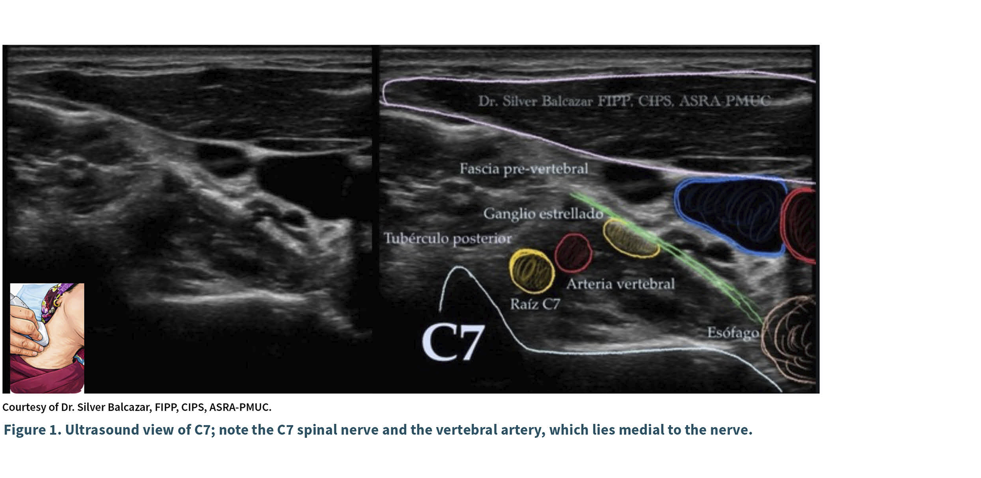 Ultrasonido que muestra la vista del nervio espinal C7 y la arteria vertebral con etiquetas anatómicas en un estilo educativo médico.

Descripción generada con IA