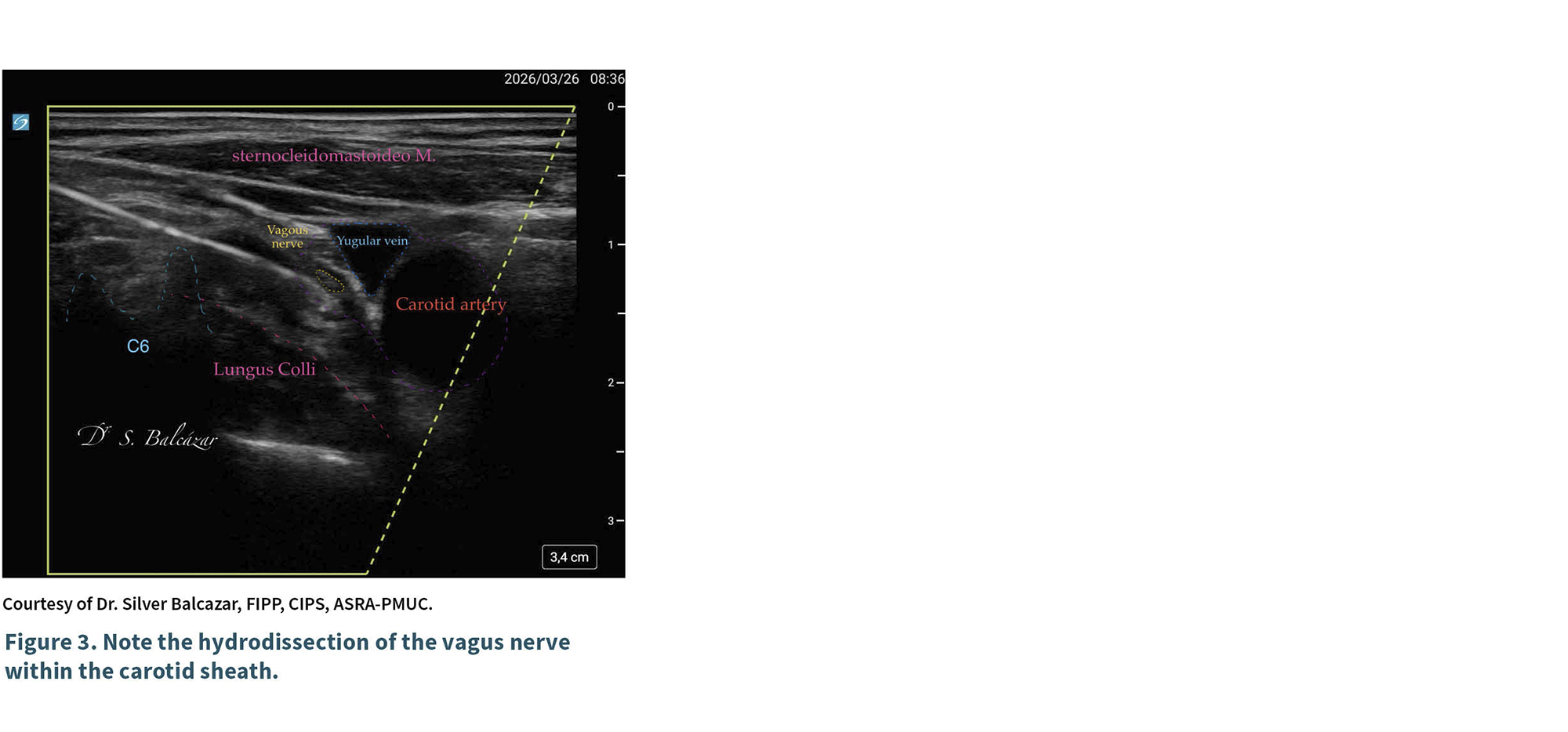 Ultrasonido que muestra la hidrodisección del nervio vago dentro de la vaina carotídea con etiquetas anatómicas visibles.

Descripción generada con IA